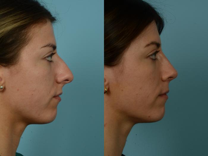 Before & After Rhinoplasty by Dr. Sinno Case 917 Right Side View in Chicago, IL