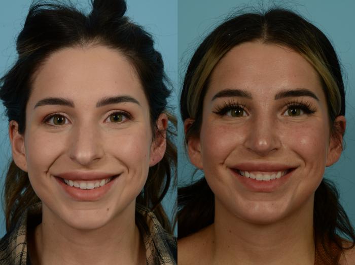 Before & After Rhinoplasty by Dr. Sinno Case 918 Front View in Chicago, IL