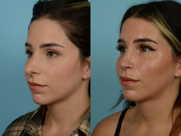 Before & After Rhinoplasty by Dr. Sinno Case 918 Left Oblique View in Chicago, IL