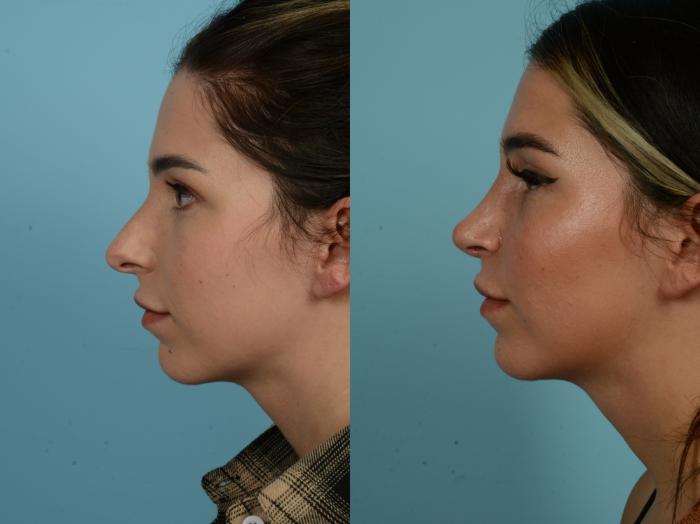 Before & After Rhinoplasty by Dr. Sinno Case 918 Left Side View in Chicago, IL