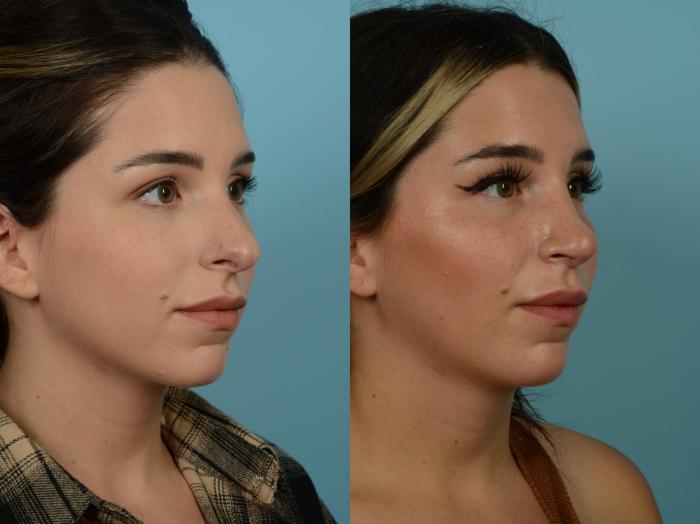Before & After Rhinoplasty by Dr. Sinno Case 918 Right Oblique View in Chicago, IL
