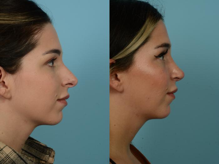 Before & After Rhinoplasty by Dr. Sinno Case 918 Right Side View in Chicago, IL