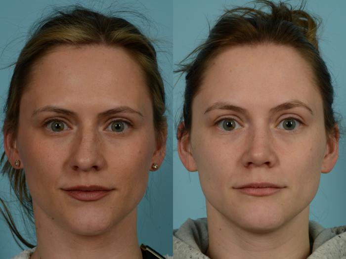 Before & After Rhinoplasty by Dr. Sinno Case 923 Front View in Chicago, IL