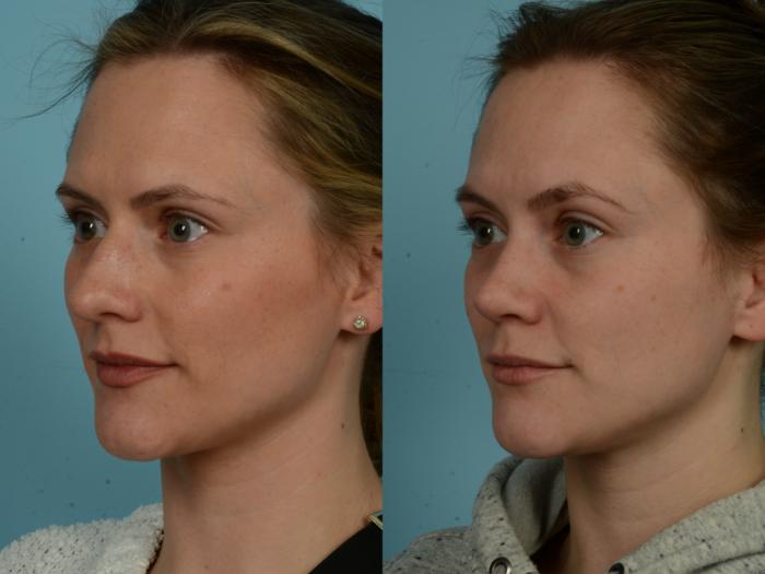 Before & After Rhinoplasty by Dr. Sinno Case 923 Left Oblique View in Chicago, IL