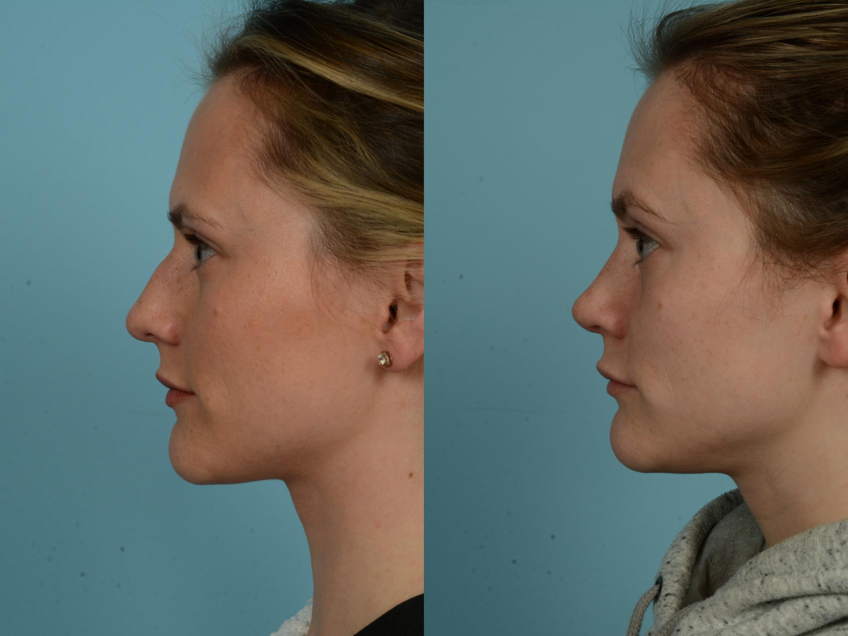 Before & After Rhinoplasty by Dr. Sinno Case 923 Left Side View in Chicago, IL