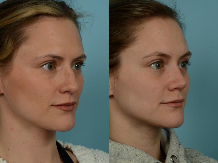 Before & After Rhinoplasty by Dr. Sinno Case 923 Right Oblique View in Chicago, IL