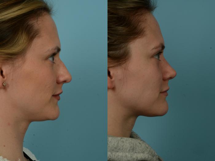 Before & After Rhinoplasty by Dr. Sinno Case 923 Right Side View in Chicago, IL