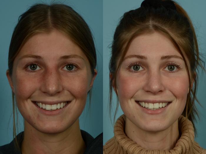 Before & After Rhinoplasty by Dr. Sinno Case 967 Front View in Chicago, IL