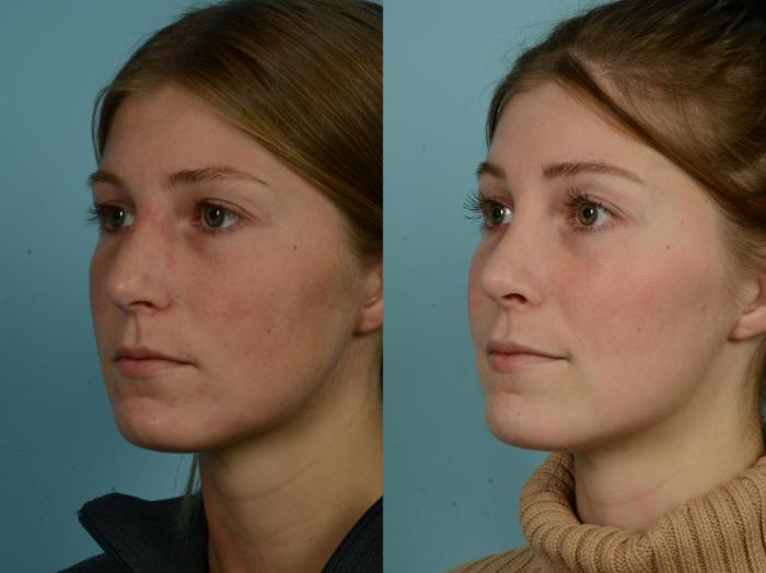 Before & After Rhinoplasty by Dr. Sinno Case 967 Left Oblique View in Chicago, IL