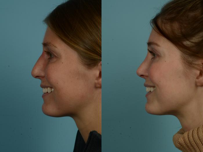 Before & After Rhinoplasty by Dr. Sinno Case 967 Left Side View in Chicago, IL