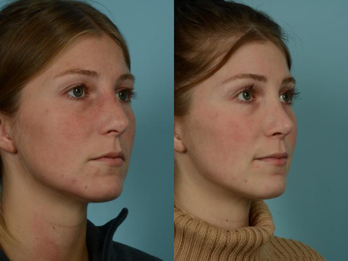 Before & After Rhinoplasty by Dr. Sinno Case 967 Right Oblique View in Chicago, IL