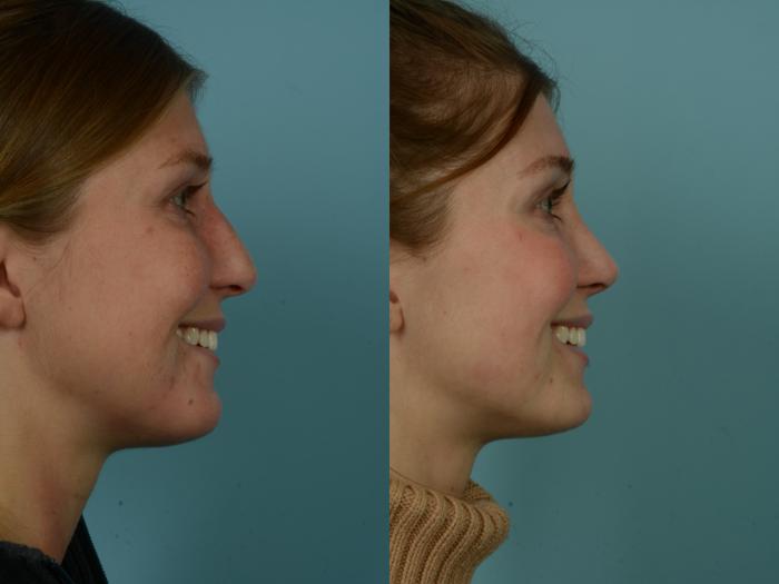 Before & After Rhinoplasty by Dr. Sinno Case 967 Right Side View in Chicago, IL