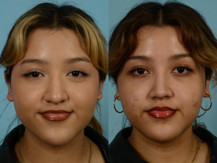 Before & After Rhinoplasty by Dr. Sinno Case 968 Front View in Chicago, IL