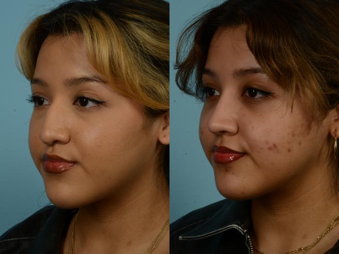 Before & After Rhinoplasty by Dr. Sinno Case 968 Left Oblique View in Chicago, IL