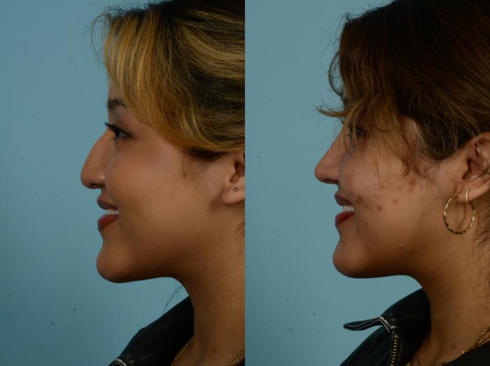 Before & After Rhinoplasty by Dr. Sinno Case 968 Left Side View in Chicago, IL