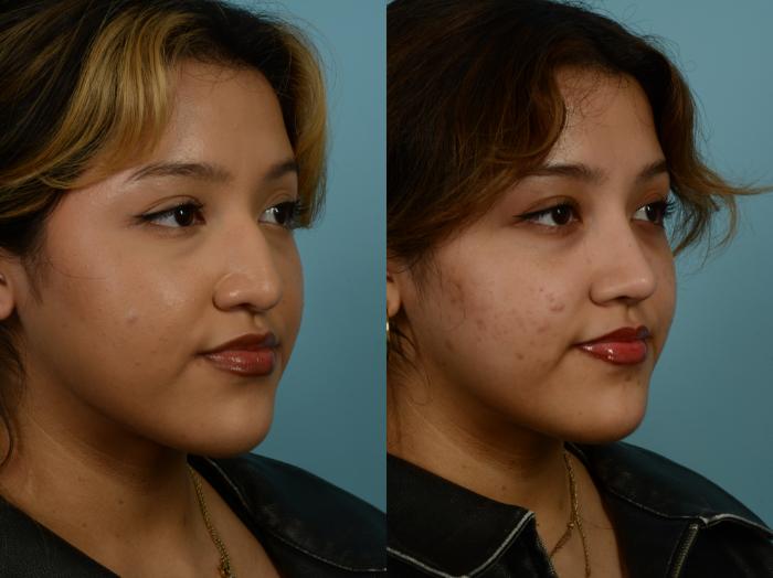 Before & After Rhinoplasty by Dr. Sinno Case 968 Right Oblique View in Chicago, IL