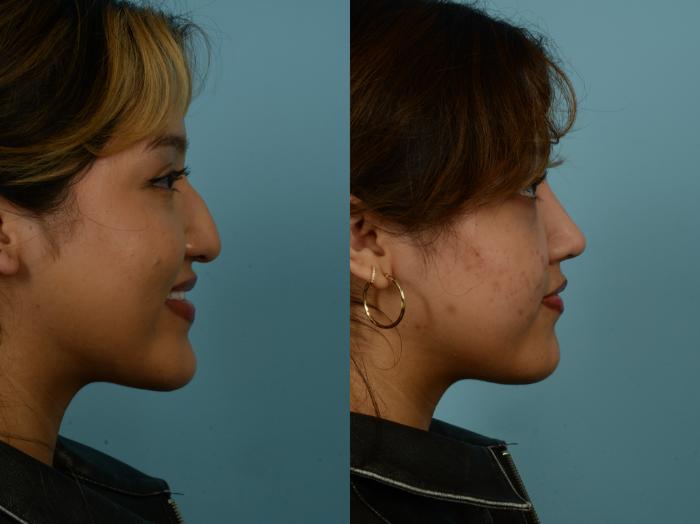 Before & After Rhinoplasty by Dr. Sinno Case 968 Right Side View in Chicago, IL