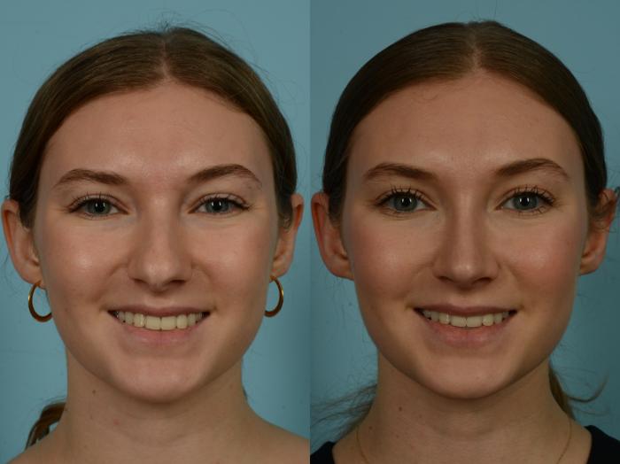Before & After Rhinoplasty by Dr. Sinno Case 974 Front View in Chicago, IL