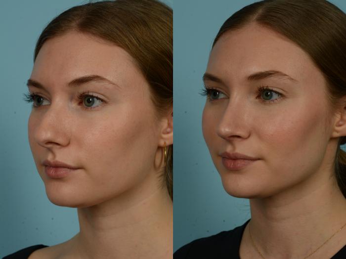 Before & After Rhinoplasty by Dr. Sinno Case 974 Left Oblique View in Chicago, IL