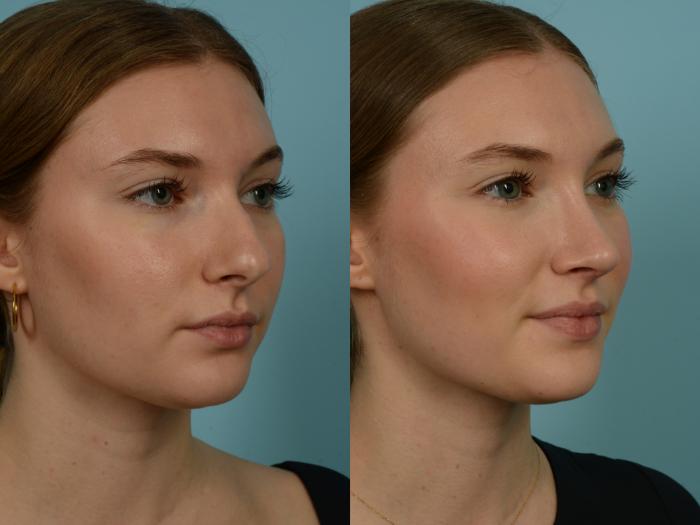 Before & After Rhinoplasty by Dr. Sinno Case 974 Right Oblique View in Chicago, IL