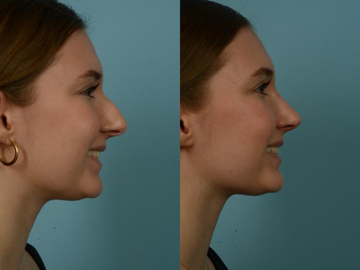 Before & After Rhinoplasty by Dr. Sinno Case 974 Right Side View in Chicago, IL