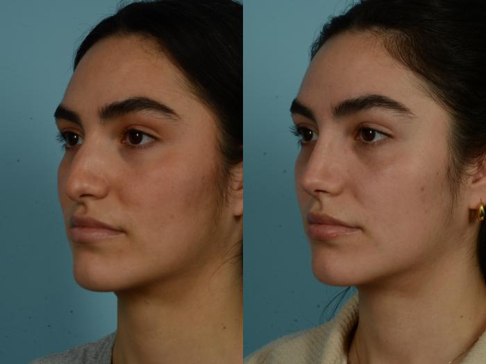 Before & After Rhinoplasty by Dr. Sinno Case 986 Left Oblique View in Chicago, IL