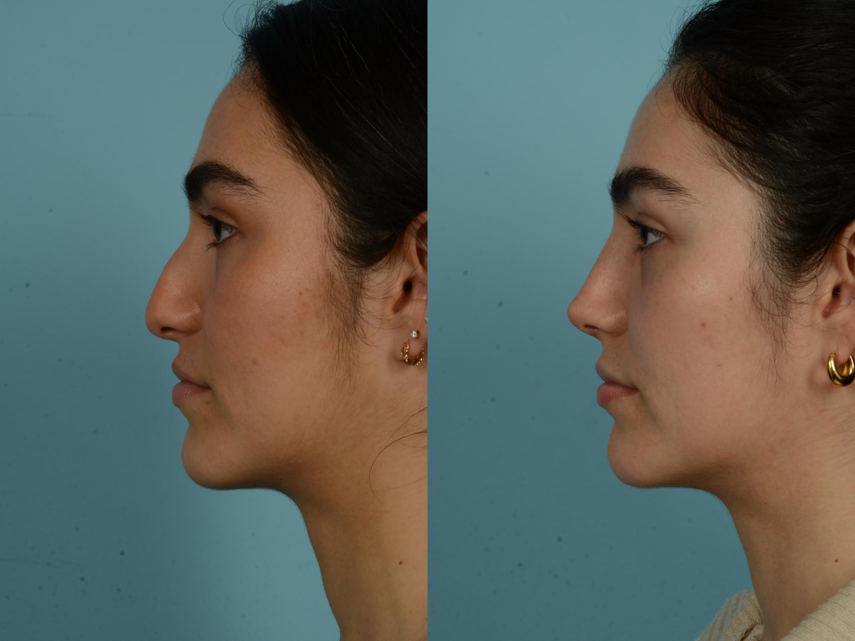 Before & After Rhinoplasty by Dr. Sinno Case 986 Left Side View in Chicago, IL