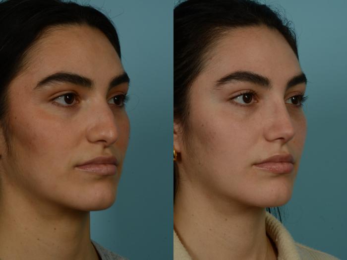 Before & After Rhinoplasty by Dr. Sinno Case 986 Right Oblique View in Chicago, IL