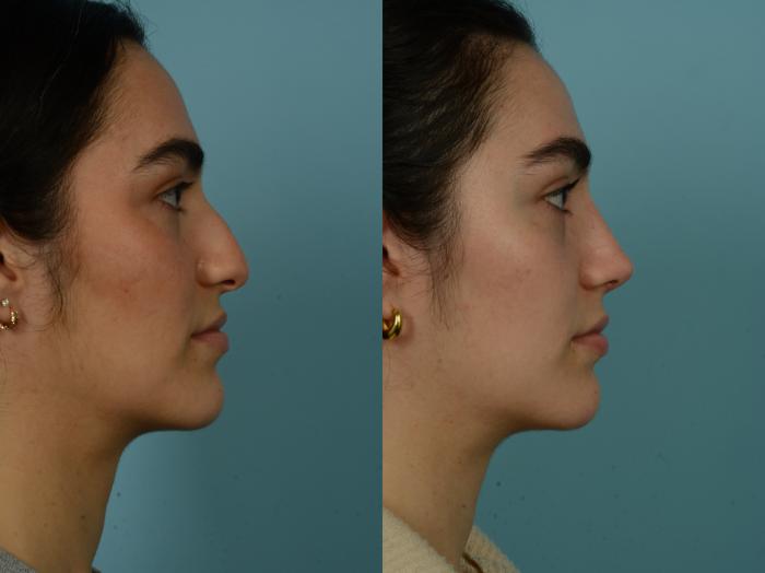 Before & After Rhinoplasty by Dr. Sinno Case 986 Right Side View in Chicago, IL