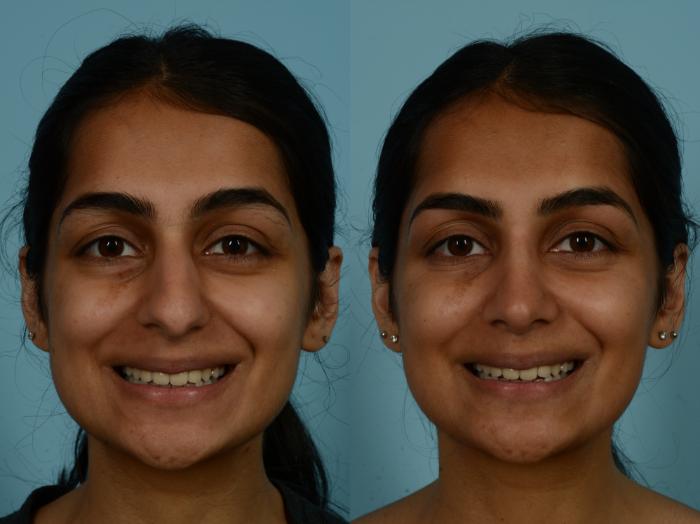 Before & After Rhinoplasty by Dr. Sinno Case 993 Front View in Chicago, IL