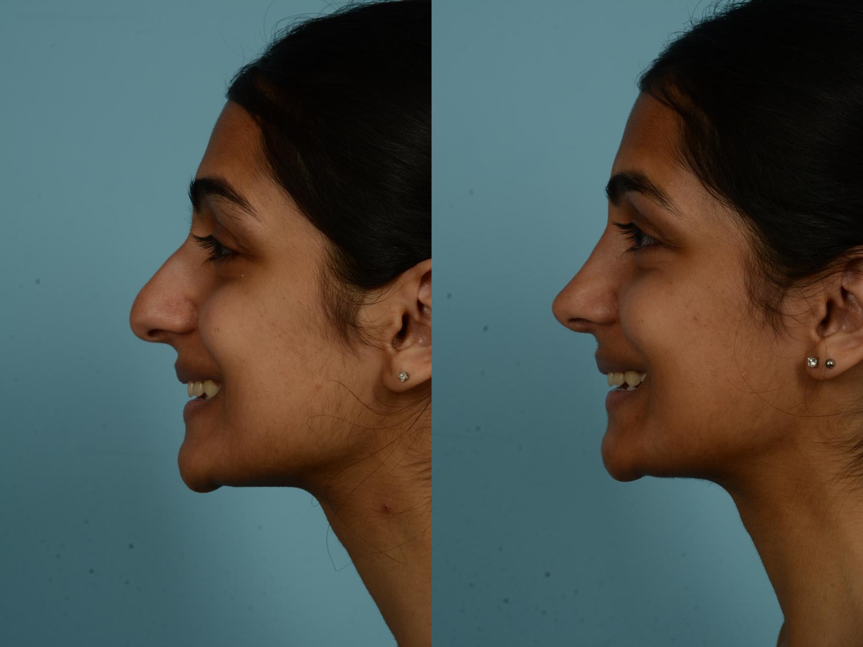 Before & After Rhinoplasty by Dr. Sinno Case 993 Left Side View in Chicago, IL