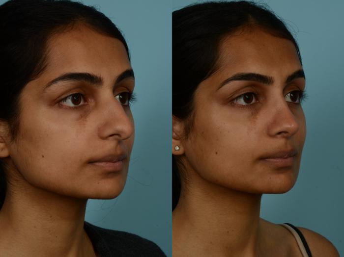 Before & After Rhinoplasty by Dr. Sinno Case 993 Right Oblique View in Chicago, IL