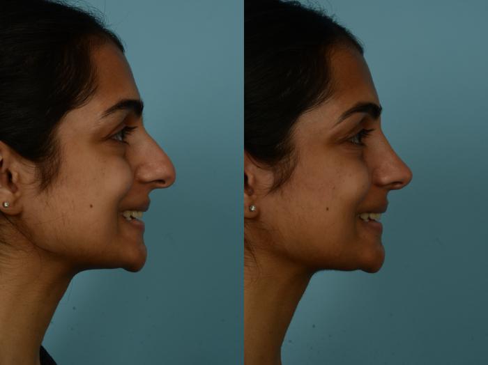 Before & After Rhinoplasty by Dr. Sinno Case 993 Right Side View in Chicago, IL