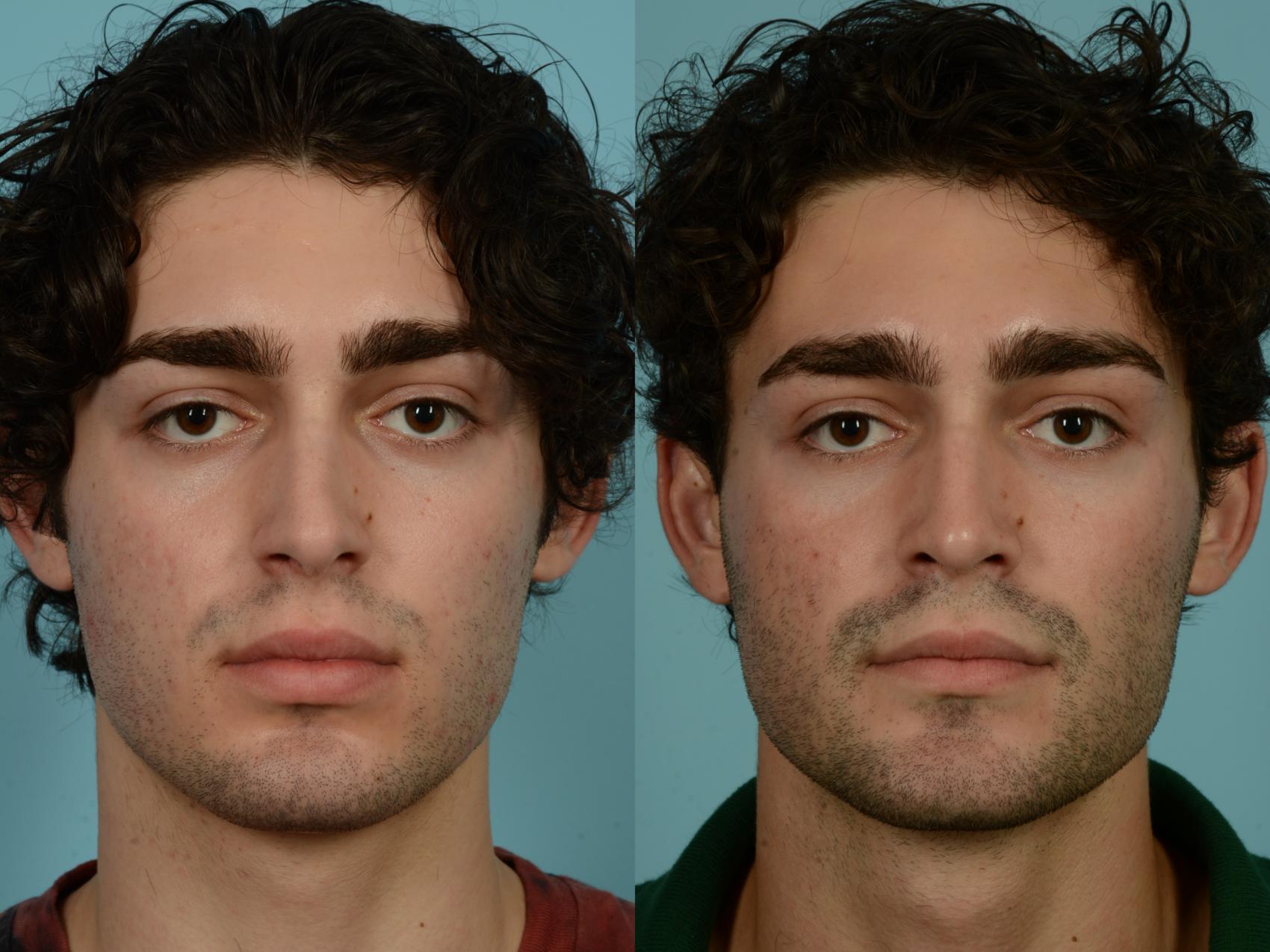 Before & After Rhinoplasty by Dr. Sinno Case 996 Front View in Chicago, IL