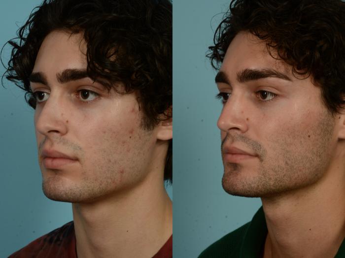 Before & After Rhinoplasty by Dr. Sinno Case 996 Left Oblique View in Chicago, IL