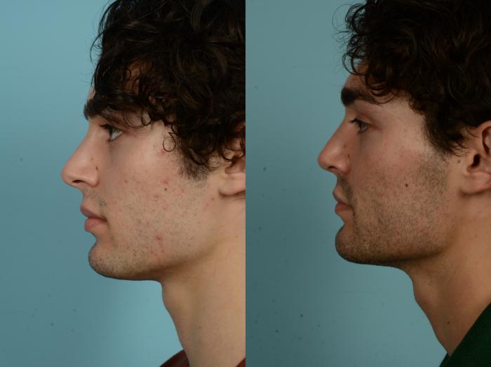 Before & After Rhinoplasty by Dr. Sinno Case 996 Left Side View in Chicago, IL