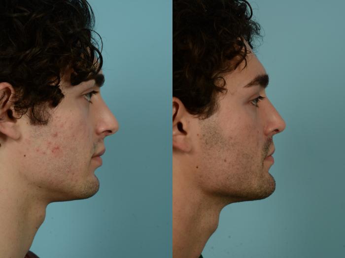 Before & After Rhinoplasty by Dr. Sinno Case 996 Right Side View in Chicago, IL