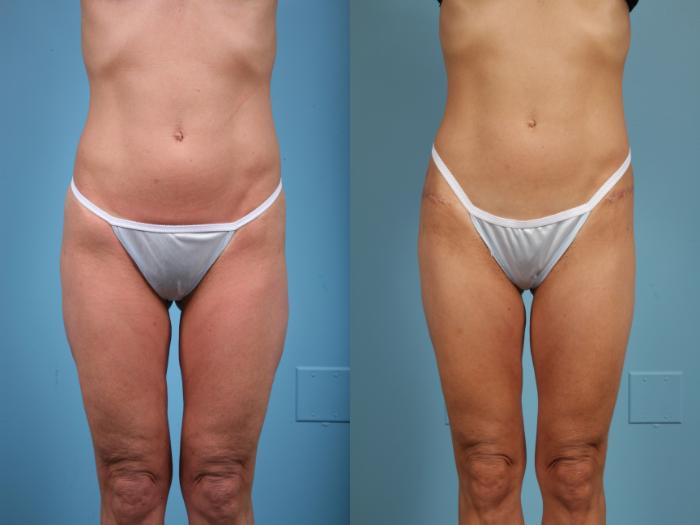 Before & After Thigh Lift Case 43 View #1 View in Chicago, IL