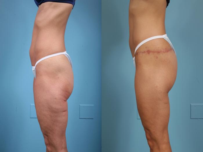 Before & After Thigh Lift Case 43 View #2 View in Chicago, IL