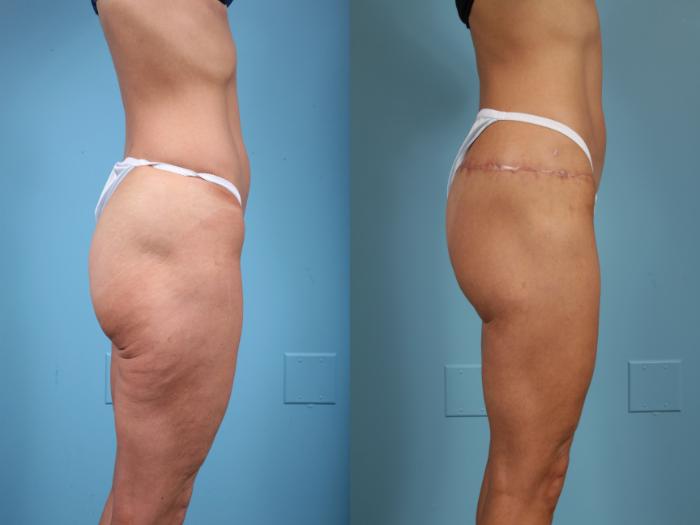 Before & After Thigh Lift Case 43 View #3 View in Chicago, IL