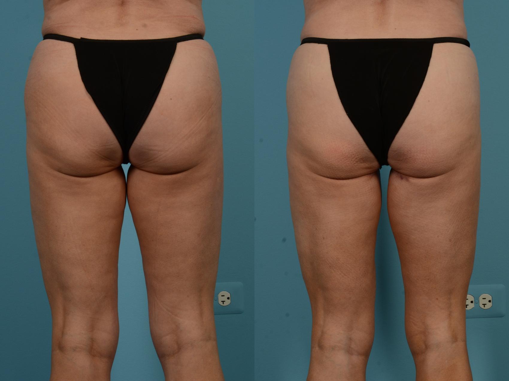 Before & After Thigh Lift by Dr. Mustoe Case 1106 Back View in Chicago, IL