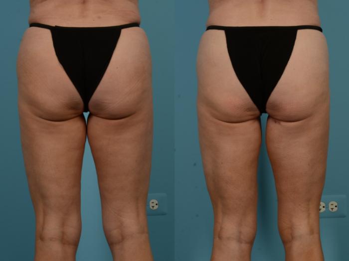 Before & After Thigh Lift by Dr. Mustoe Case 1106 Back View in Chicago, IL