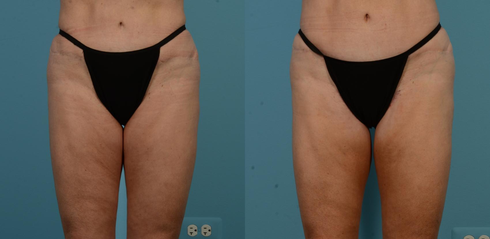 Before & After Thigh Lift by Dr. Mustoe Case 1106 Front View in Chicago, IL