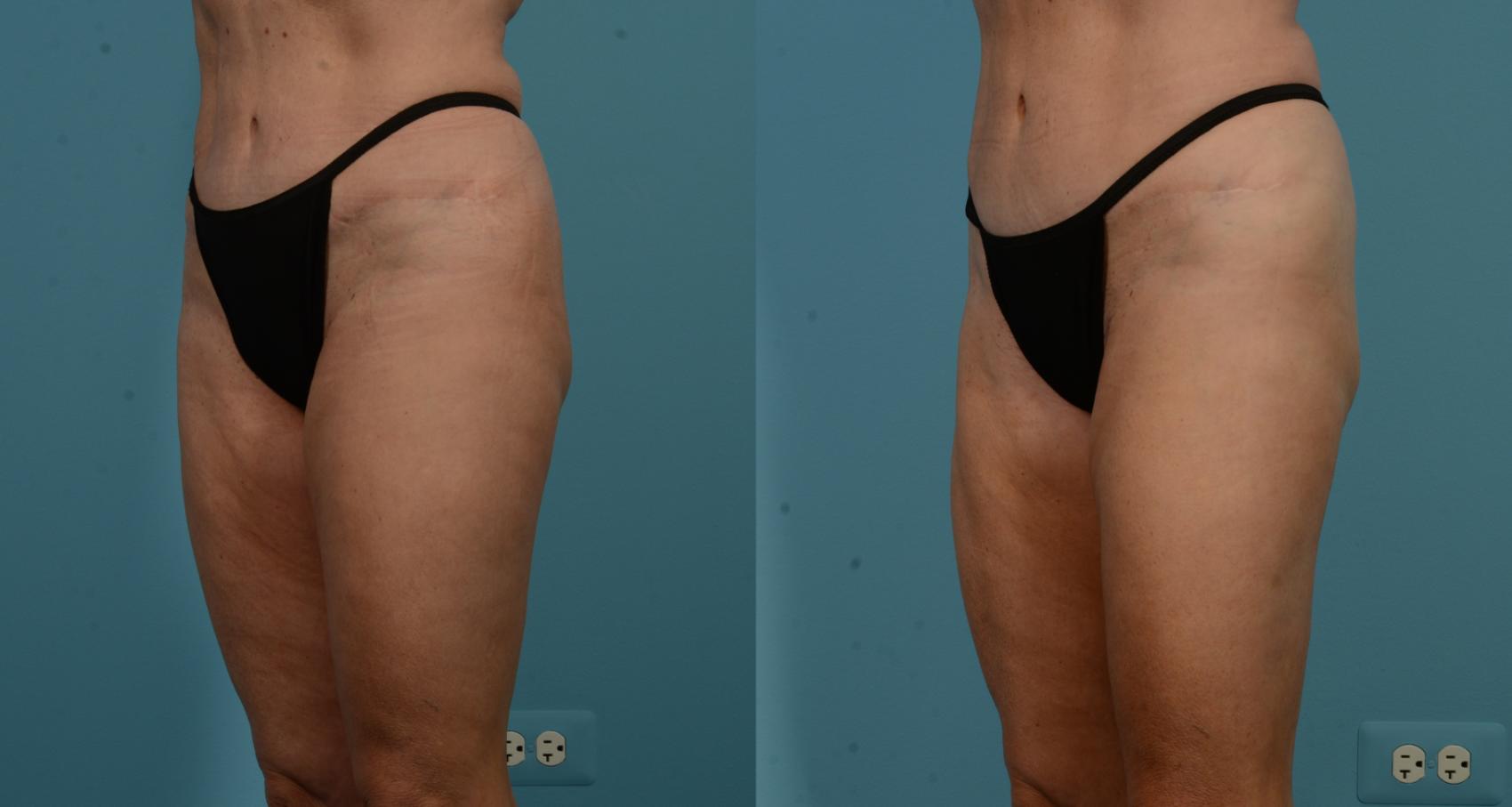 Before & After Thigh Lift by Dr. Mustoe Case 1106 Left Oblique View in Chicago, IL