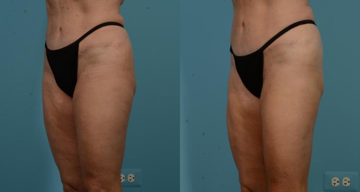 Before & After Thigh Lift by Dr. Mustoe Case 1106 Left Oblique View in Chicago, IL