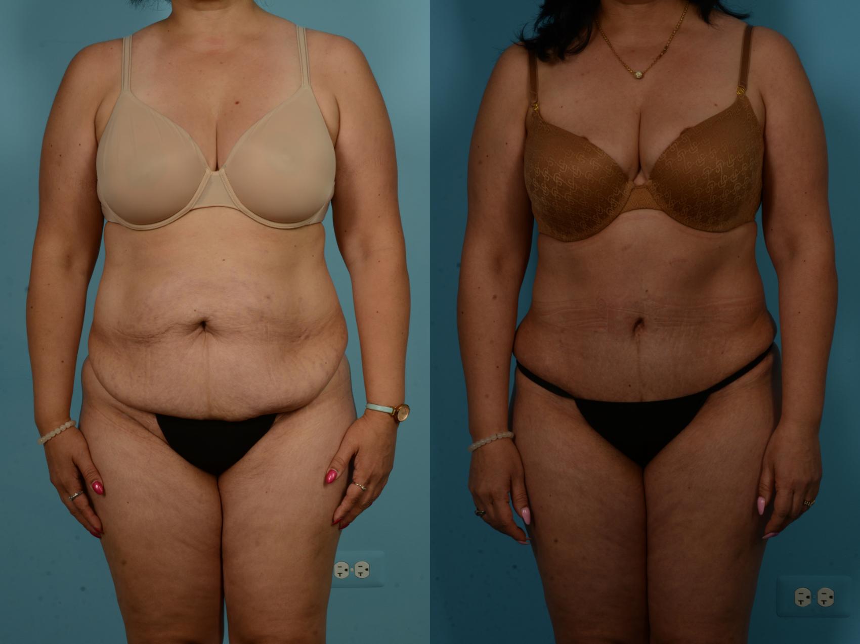 Before & After Tummy Tuck Case 1019 Front View in Chicago, IL