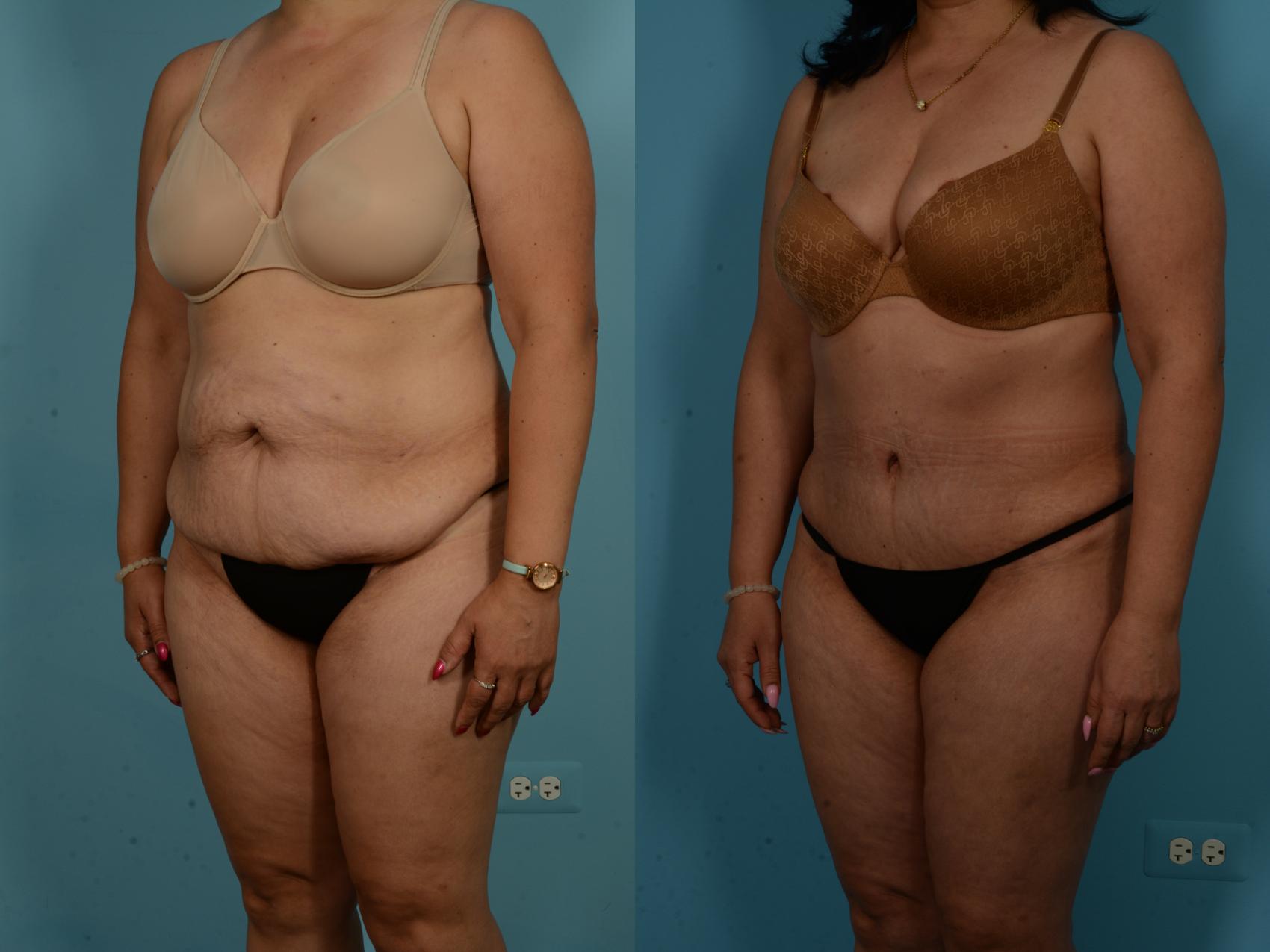Before & After Tummy Tuck by Dr. Sinno Case 1019 Left Oblique View in Chicago, IL
