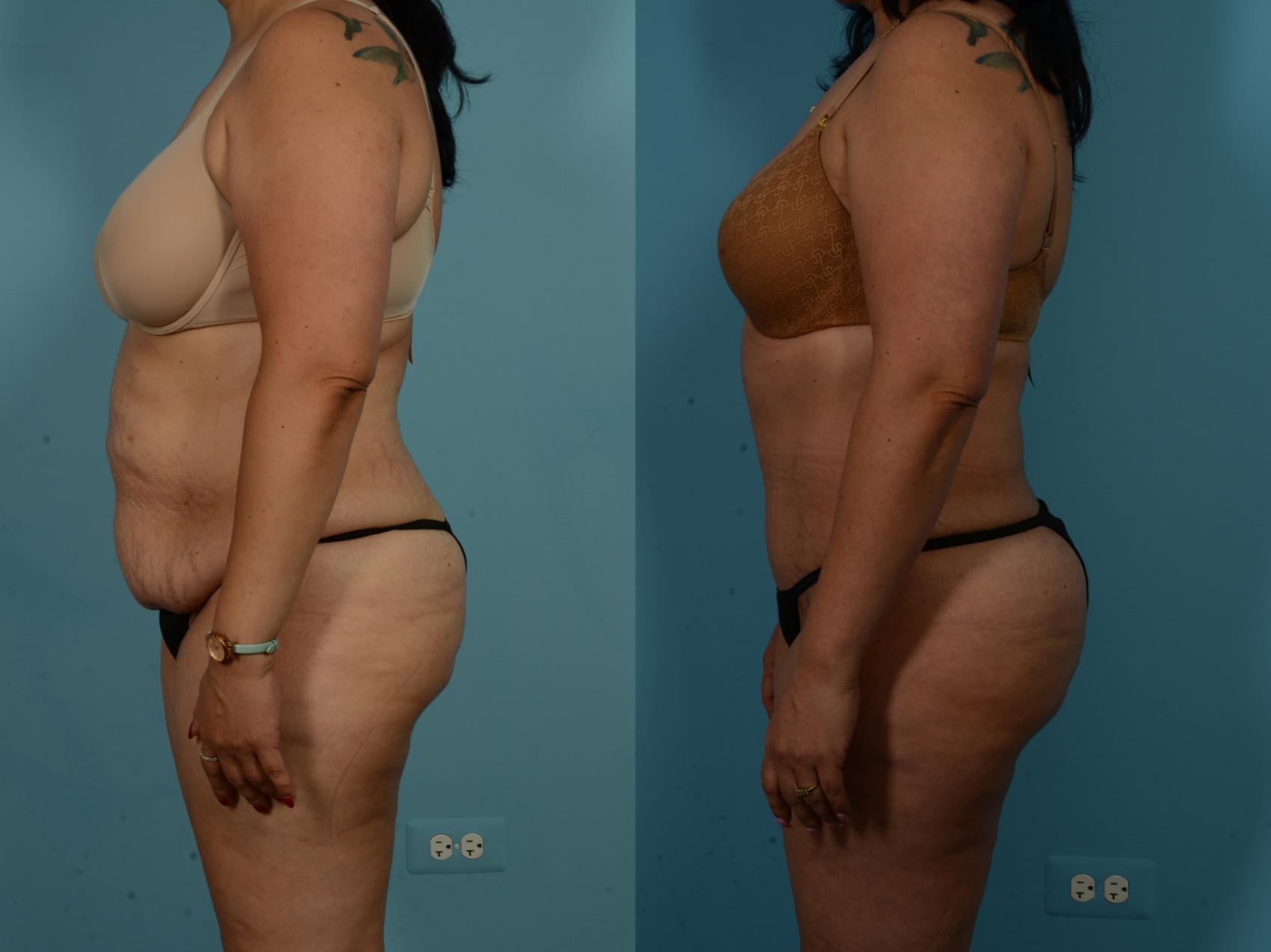 Before & After Tummy Tuck by Dr. Sinno Case 1019 Left Side View in Chicago, IL