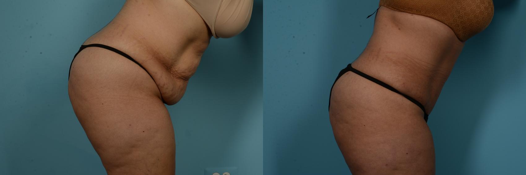 Before & After Tummy Tuck by Dr. Sinno Case 1019 Modified Side View View in Chicago, IL