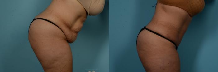 Before & After Tummy Tuck Case 1019 Modified Side View View in Chicago, IL